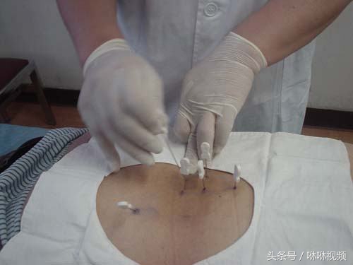 风湿滑膜炎怎么治疗最有效,自述髋关节滑膜炎康复经历