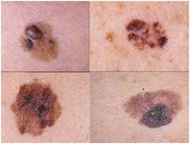 身上的痣去掉对今后有改观吗,身上有痣经常搓澡有癌变的可能吗