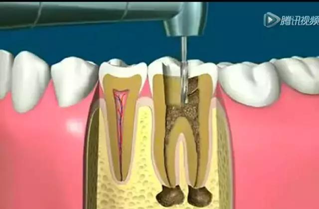 大名“根管治疗”，小名“抽神经”，诊疗要求：全冠保护
