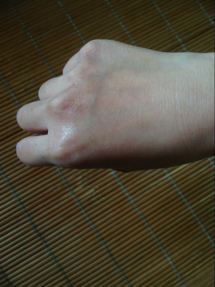 鍑濊兌闈㈣啘,鍑濊兌鑳跺師铔嬬櫧闈㈣啘