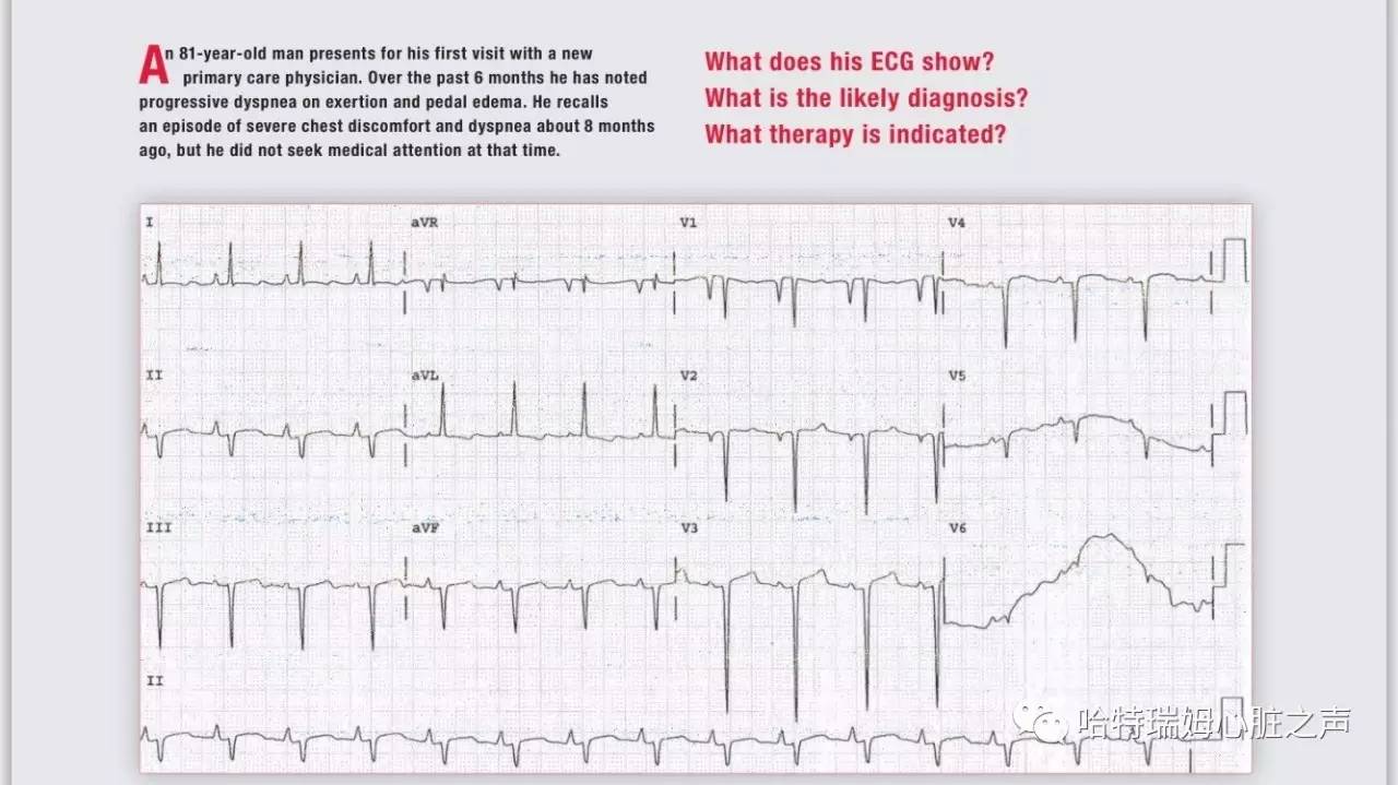 读心有术216,心电图出现双尖心室肥大