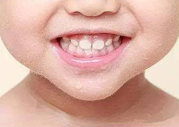 孩子刷牙了可是牙还是黄的,宝宝不爱刷牙怎么预防龋齿