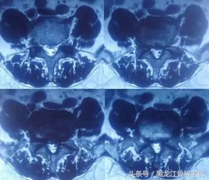 病例分享丨微创疗法让老人远离“腰突”困扰