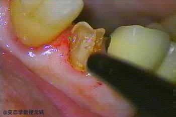 牙齿烂了一个大窟窿可以杀神经吗,牙齿坏了杀神经对身体会有伤害吗