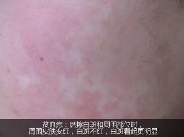 不是白癜风的白斑能查出是什么吗,不是白癜风的白点是啥