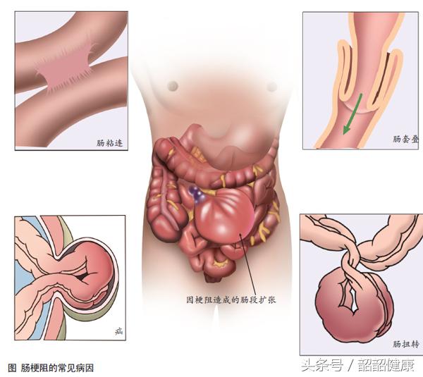 剖腹产后用开塞露也没排气怎么办,剖腹产术后不排气可以用开塞露吗