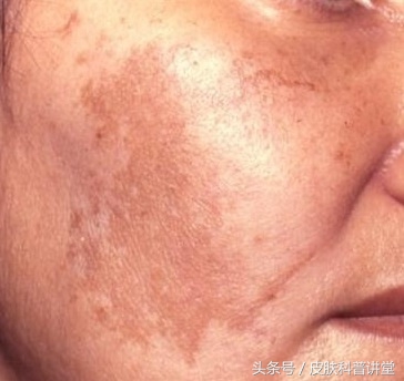 褐斑的原因和治疗方法,褐斑最佳治疗方法