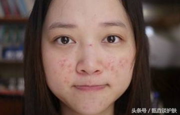 如何去除痘印痘疤痘坑,如何去除痘印留下的痣