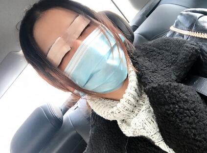 割双眼皮一个月效果,40岁割双眼皮效果好不