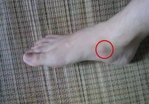 打完球足弓疼痛是不是扁平足,打完球脚踝足弓痛是怎么回事