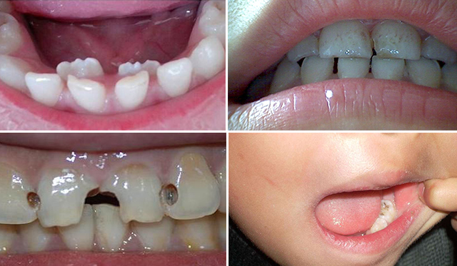 小孩子换牙要去看牙医吗,孩子换牙期一定要拔牙吗