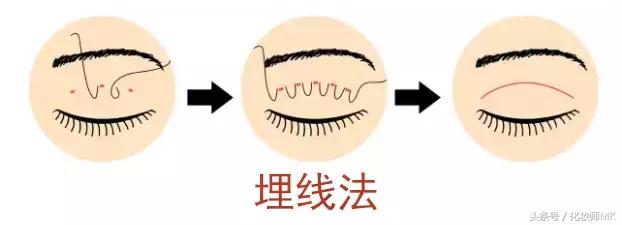 真实贴双眼皮贴,单眼皮怎么贴第二天变双眼皮