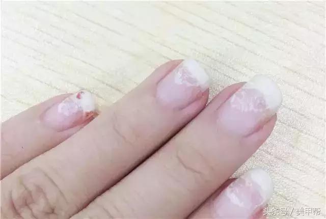 喜欢抠指甲是不是一种病,喜欢抠指甲皮会怎么样