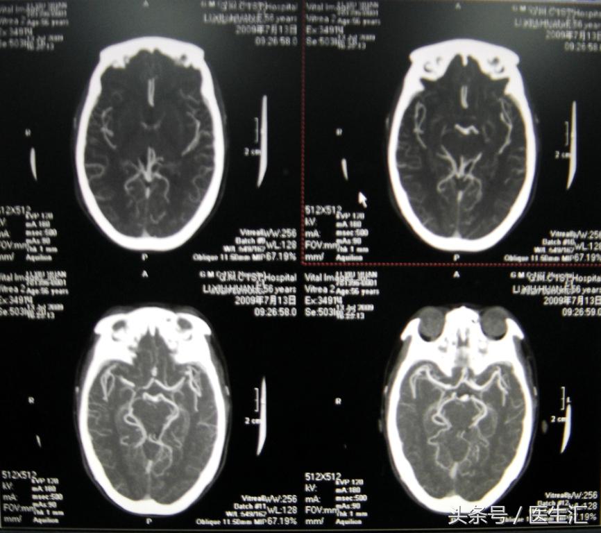 脑溶栓治疗一般多少钱,溶栓治疗需要多少费用