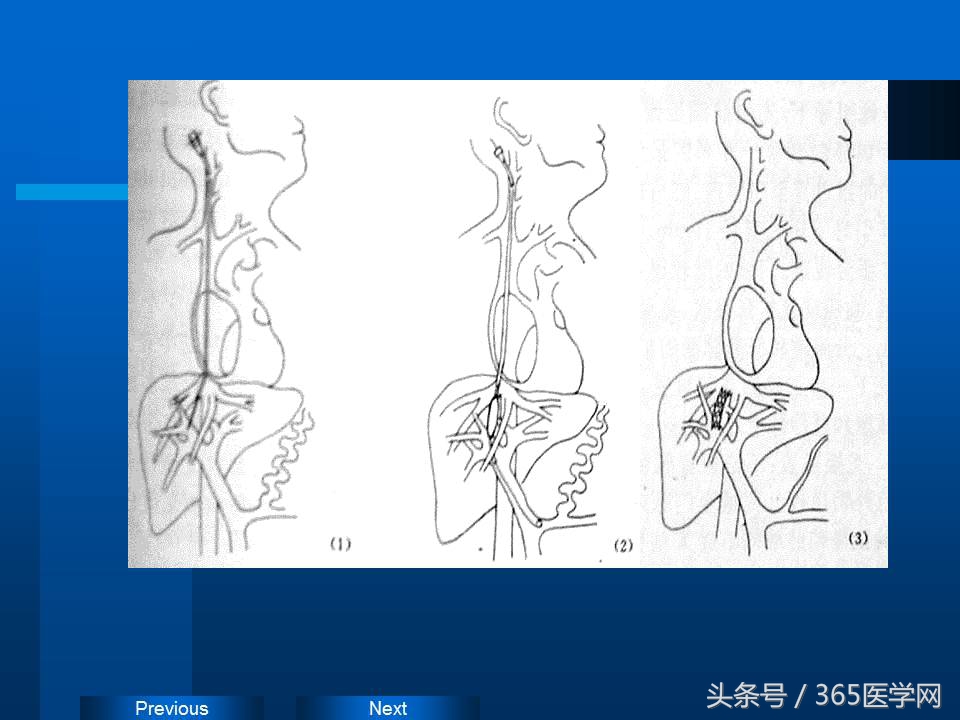 崔进国：消化道出血的介入治疗