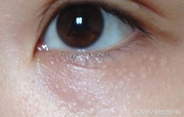 眼睛长脂肪粒怎么去除最简单方法,眼睛长脂肪粒怎么去除小窍门
