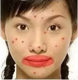 为什么长闭口粉刺痘痘还总是反复,痘痘反复长你知道是为什么吗