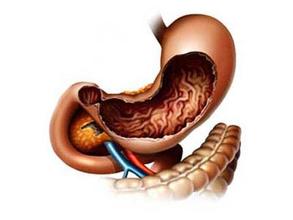 胃癌科普知识大全图片,胃癌科普小知识