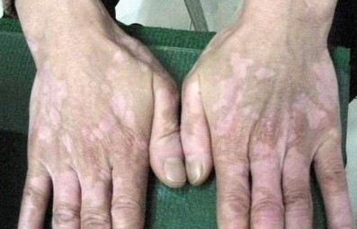 手上长白斑早期怎么预防,预防外阴白斑复发的方法是什么