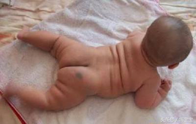 小孩皮肤胎记多,孩子身上各种颜色胎记