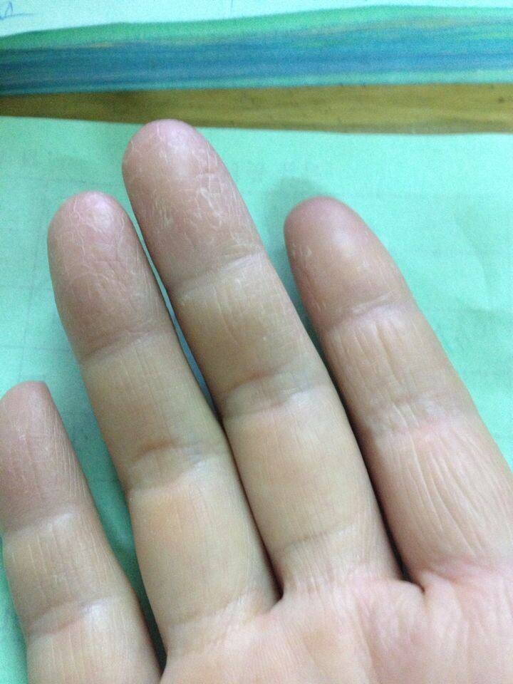 手脱皮是怎么回事怎么治疗,手脱皮是怎么回事怎么治