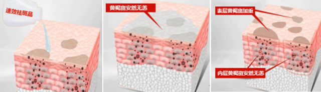 褐斑怎么治疗有效,褐斑怎么治疗效果最好