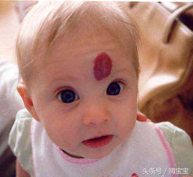 青色胎记会影响健康吗,小孩的胎记会影响身体吗