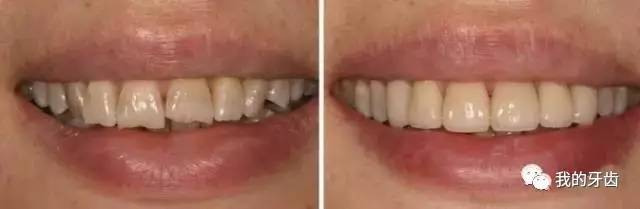 冷光美白牙齿靠谱吗,牙齿美白全过程视频