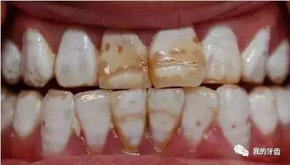 冷光美白牙齿靠谱吗,牙齿美白全过程视频