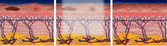 褐斑怎么治疗有效,褐斑怎么治疗效果最好