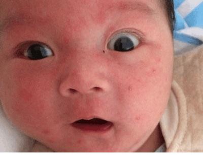 宝宝小红疙瘩怎么回事,宝宝小疙瘩