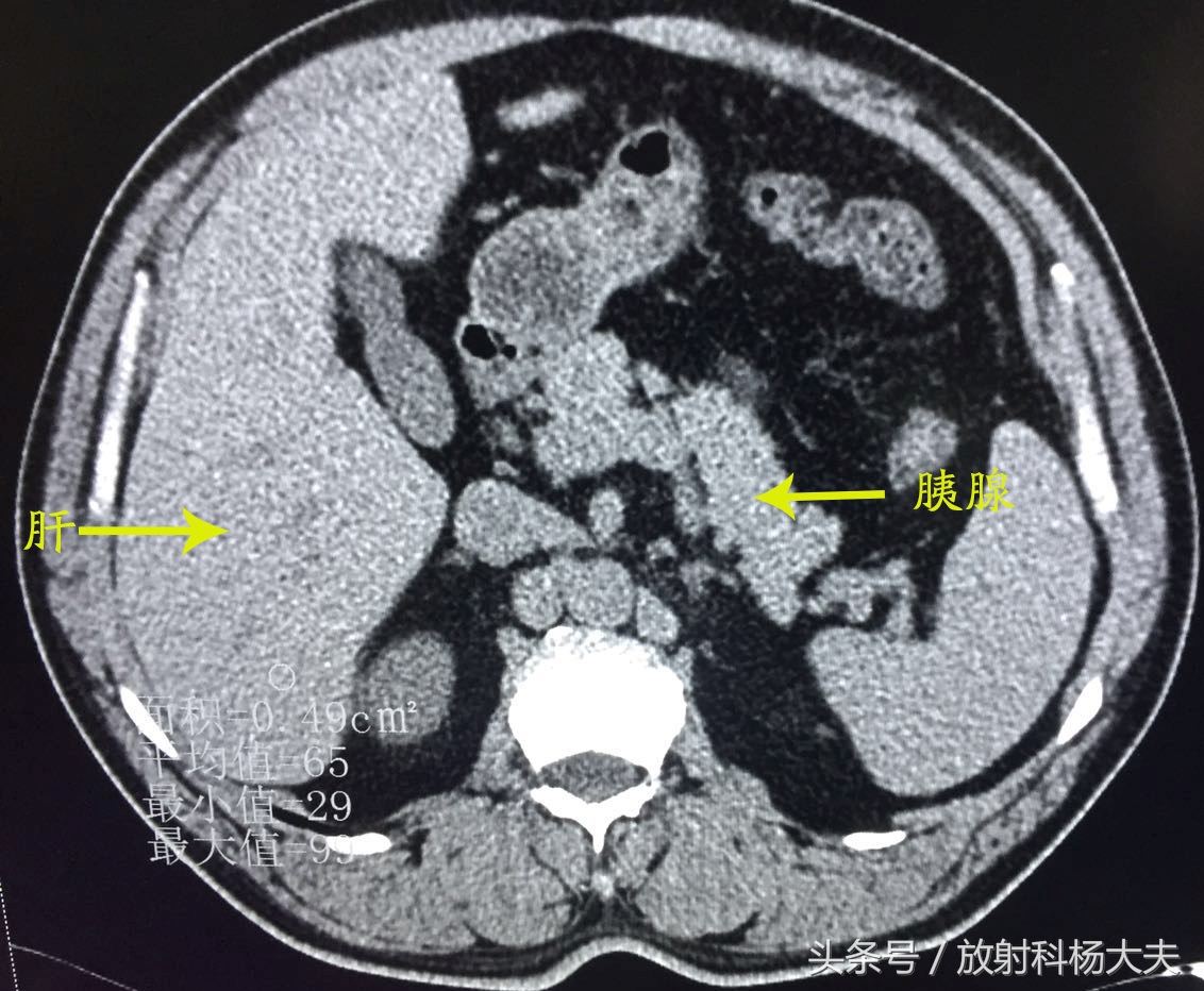 胰腺占位饭后肚子痛,吃火锅后肚子隐隐作痛