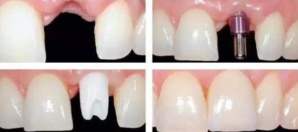 牙齿掉了一颗镶牙要多少钱,最后一颗牙齿掉了怎么镶牙