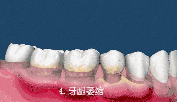 为什么使劲吸牙齿就会出血,为什么用力一吸就出血