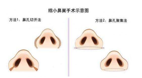 缩小鼻翼整容过程,如何自然缩小鼻翼