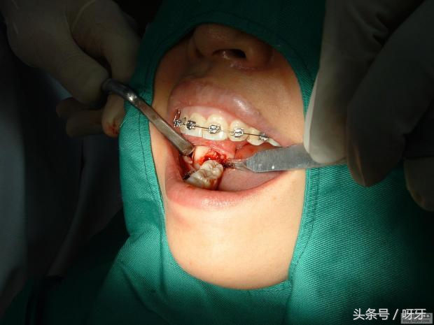 长出来的智齿真的有必要拔吗,智齿已经长出来了拔除难度大吗