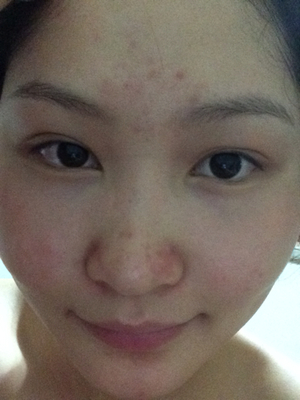 消了又长的疮是什么疮,脸部长疮的症状和治疗方法