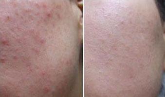 武汉彩光祛雀斑怎么样,武汉哪里做激光祛痘比较好