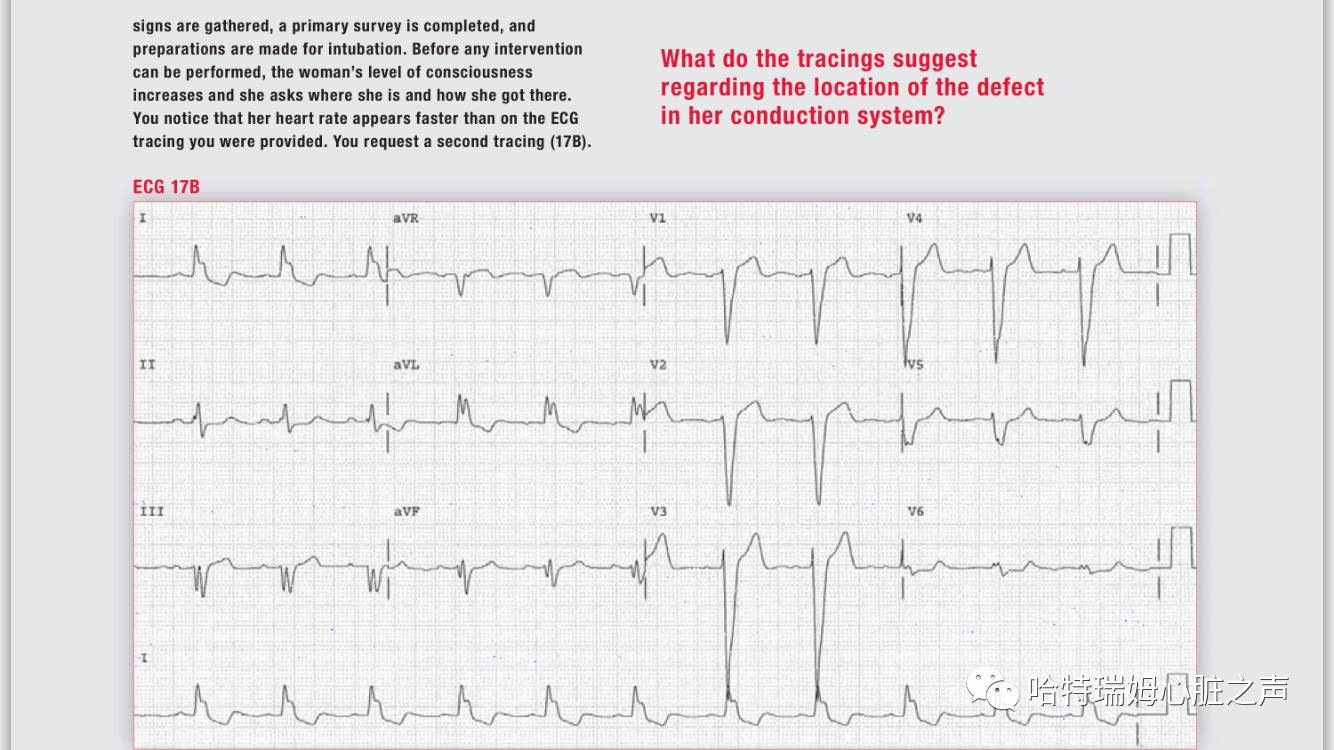 读心有术171,读心有术心电图