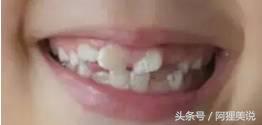 换牙期间怎么做才能让牙齿长整齐,小孩牙齿长得太疏换牙会丑吗