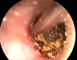 怎样才能挖到这么大块耳屎?恶心!但看着好爽啊!