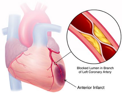 右胸痛是心肌梗死吗,肩背痛胸痛原来是心肌梗死