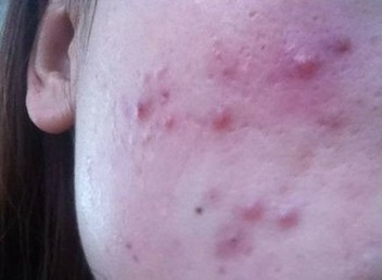 消了又长的疮是什么疮,脸部长疮的症状和治疗方法