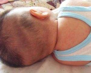 宝宝发烧后长疹子是怎么回事,小孩子发烧脸上长疹子怎么办