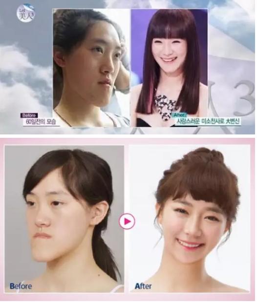 韩国整容手术恢复过程,韩国一个整容的综艺节目