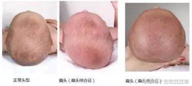 三个月宝宝平头头型,100多天宝宝头型平头还能矫正吗