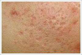 祛痘祛痘印最有效的方法小妙招,教你五种最有效的祛痘印方法