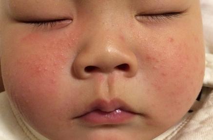 过敏性湿疹应该多吃什么水果,过敏性体质有哪几种水果要少吃