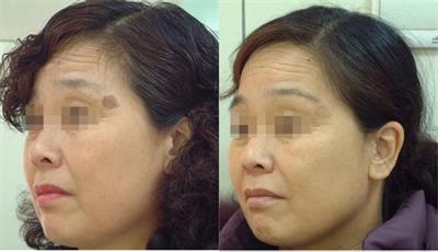 老年斑激光后复发怎么办,激光治疗老年斑祛斑视频