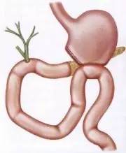 胃镜预处理流程,胃镜内镜手术全流程